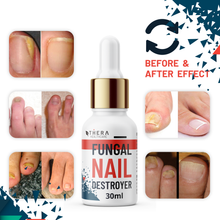 Load image into Gallery viewer, Fungal Nail Destroyer